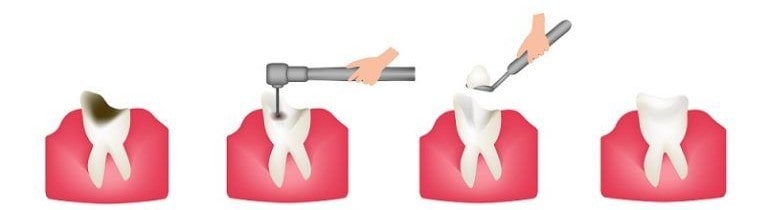 dental filling