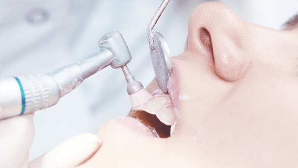 teeth cleaning