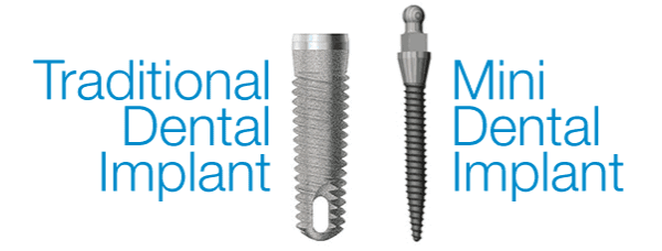 traditional dental implant and mini dental implant