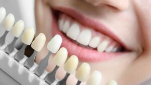 tooth whitening