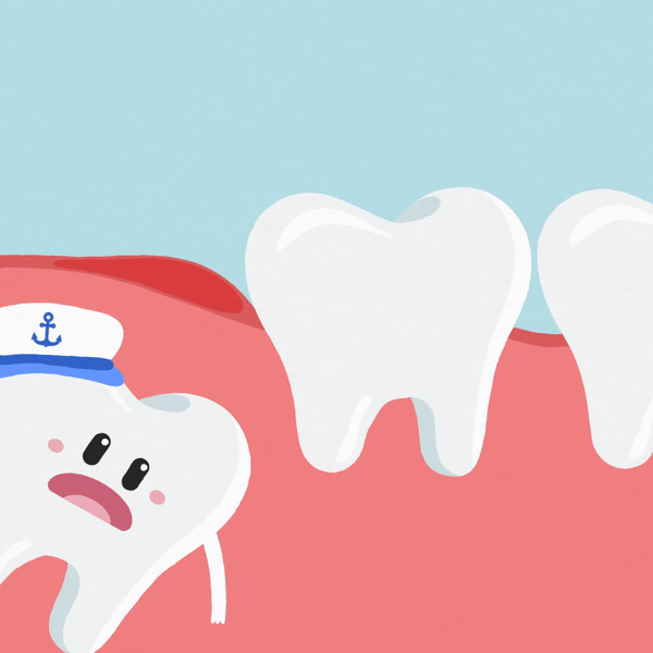 Causes of Impacted Wisdom Tooth